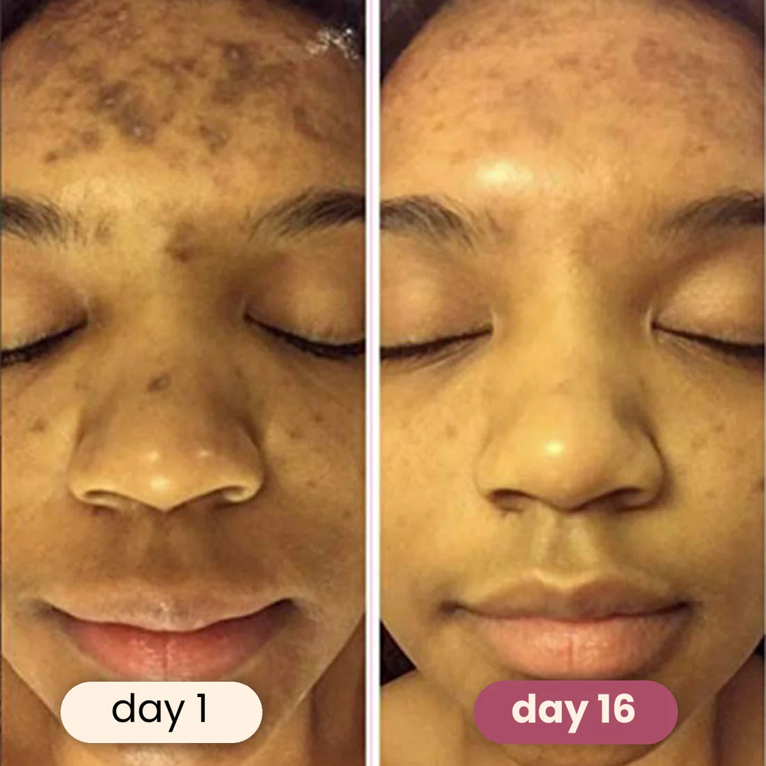 Pads Nettoyant au curcuma indien & kojic tâches rebelles